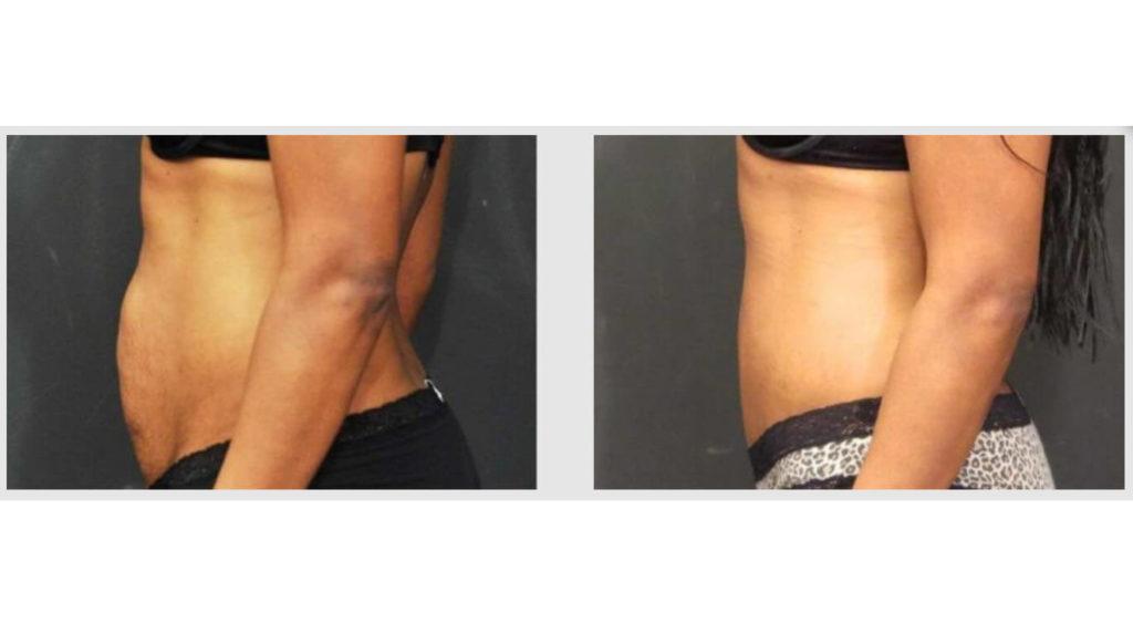 A Before and After photo of a Liposuction Plastic Surgery by Dr. Craig Jonov in Seattle and Tacoma