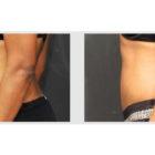 A Before and After photo of a Liposuction Plastic Surgery by Dr. Craig Jonov in Seattle and Tacoma