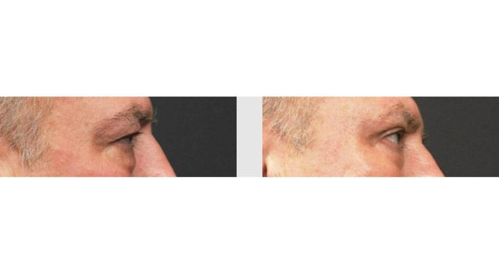 A Before and After photo of an Eyelid Lift Plastic Surgery by Dr. Craig Jonov in Seattle and Tacoma