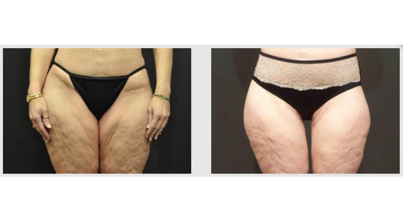 A Before and After photo of a Lower Body Lift Plastic Surgery by Dr. Craig Jonov in Seattle and Tacoma