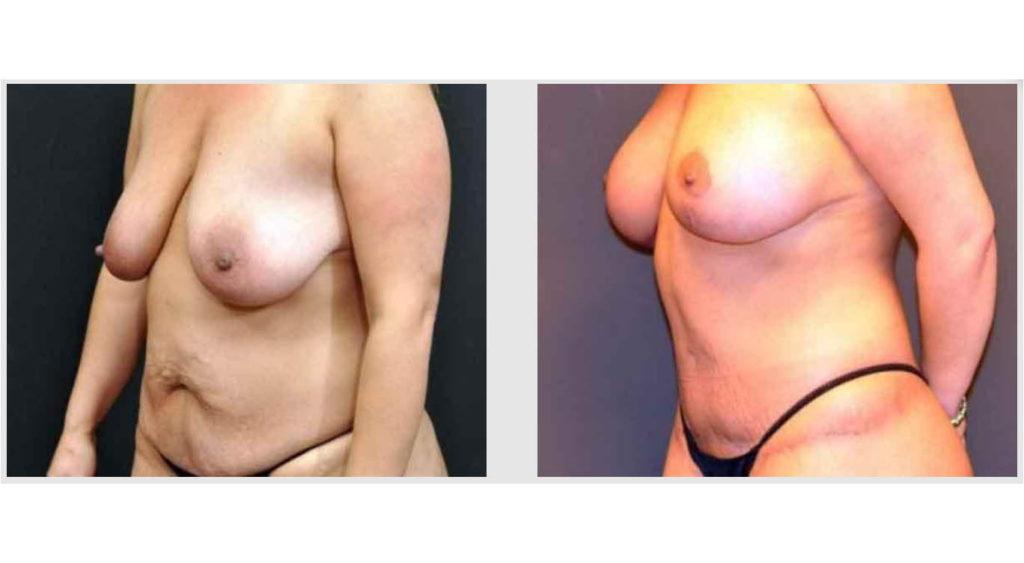 A Before and After photo of a Mommy Makeover Plastic Surgery by Dr. Craig Jonov in Seattle and Tacoma