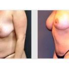 A Before and After photo of a Mommy Makeover Plastic Surgery by Dr. Craig Jonov in Seattle and Tacoma