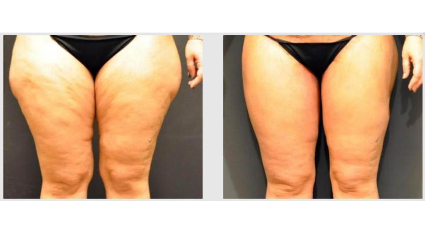 A Before and After photo of a Thigh Lift Plastic Surgery by Dr. Craig Jonov in Seattle and Tacoma