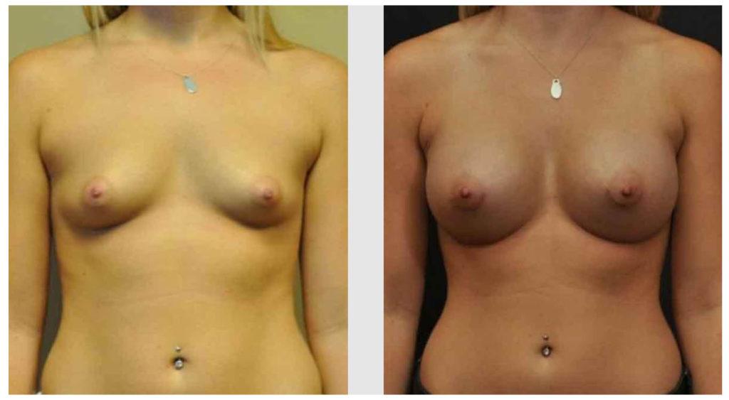 A Before and After photo of a Breast Augmentation Plastic Surgery by Dr. Craig Jonov in Seattle and Tacoma