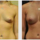 A Before and After photo of a Breast Augmentation Plastic Surgery by Dr. Craig Jonov in Seattle and Tacoma