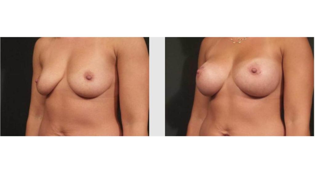 A Before and After photo of a Breast Lift Plastic Surgery by Dr. Craig Jonov in Seattle and Tacoma