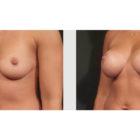 A Before and After photo of a Breast Lift Plastic Surgery by Dr. Craig Jonov in Seattle and Tacoma