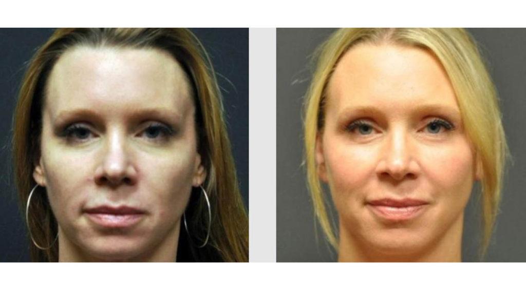 A Before and After photo of a Facelift Plastic Surgery by Dr. Craig Jonov in Seattle and Tacoma