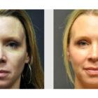 A Before and After photo of a Facelift Plastic Surgery by Dr. Craig Jonov in Seattle and Tacoma