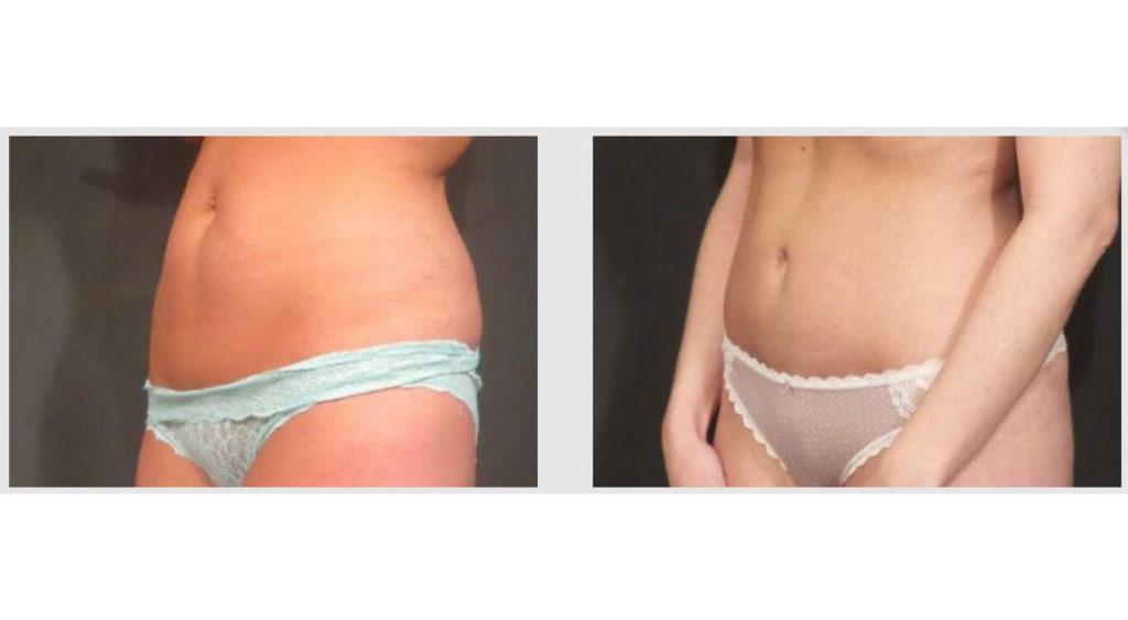 A Before and After photo of a Liposuction Plastic Surgery by Dr. Craig Jonov in Seattle and Tacoma