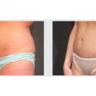 A Before and After photo of a Liposuction Plastic Surgery by Dr. Craig Jonov in Seattle and Tacoma