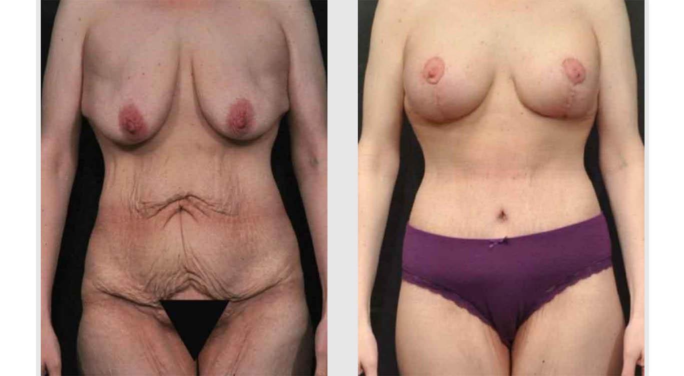 A Before and After photo of a Mommy Makeover Plastic Surgery by Dr. Craig Jonov in Seattle and Tacoma