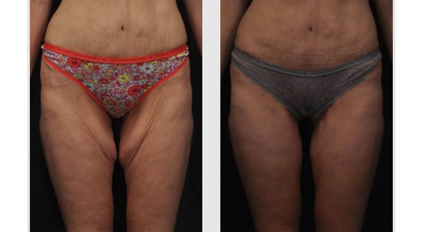 A Before and After photo of a Thigh Lift Plastic Surgery by Dr. Craig Jonov in Seattle and Tacoma