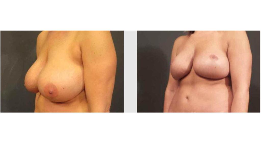 A Before and After photo of a Breast Lift Plastic Surgery by Dr. Craig Jonov in Seattle and Tacoma
