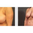 A Before and After photo of a Breast Lift Plastic Surgery by Dr. Craig Jonov in Seattle and Tacoma