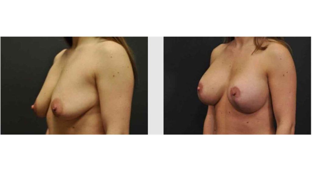A Before and After photo of a Breast Lift Plastic Surgery by Dr. Craig Jonov in Seattle and Tacoma