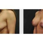 A Before and After photo of a Breast Lift Plastic Surgery by Dr. Craig Jonov in Seattle and Tacoma