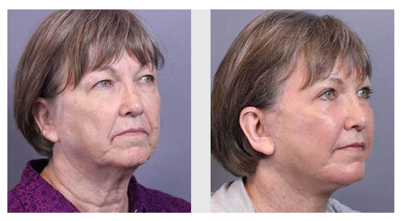 A Before and After photo of a Facelift Plastic Surgery by Dr. Craig Jonov in Seattle and Tacoma