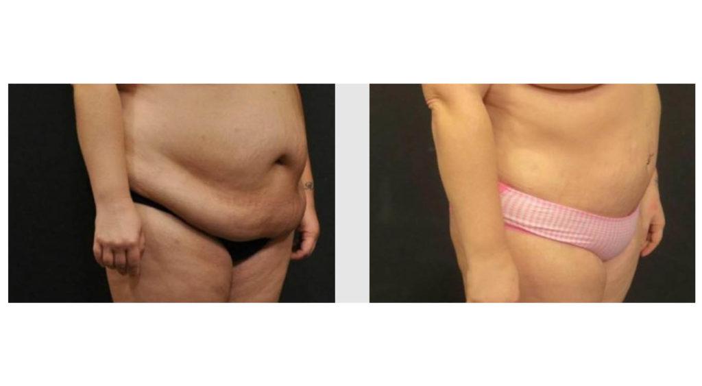 A Before and After photo of a Tummy Tuck Plastic Surgery by Dr. Craig Jonov in Seattle and Tacoma