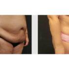 A Before and After photo of a Tummy Tuck Plastic Surgery by Dr. Craig Jonov in Seattle and Tacoma