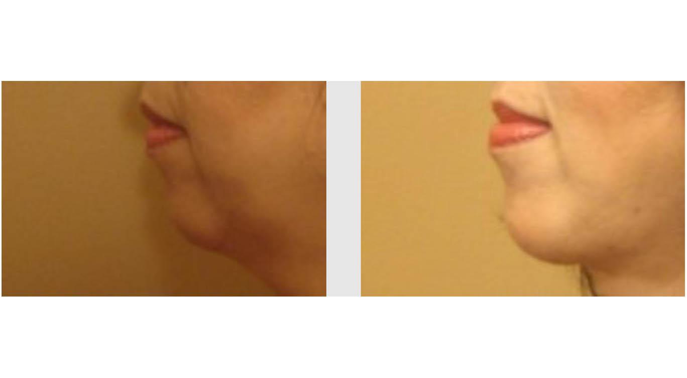 A Before and After photo of a Chin Augmentation Plastic Surgery by Dr. Craig Jonov in Seattle and Tacoma