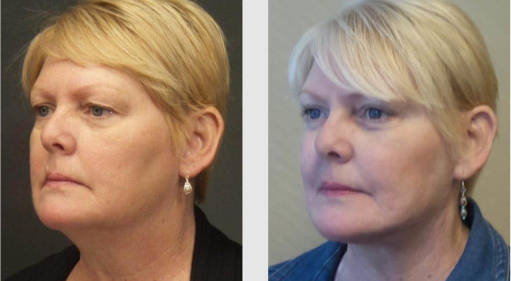 A Before and After photo of an Eyelid Lift Plastic Surgery by Dr. Craig Jonov in Seattle and Tacoma