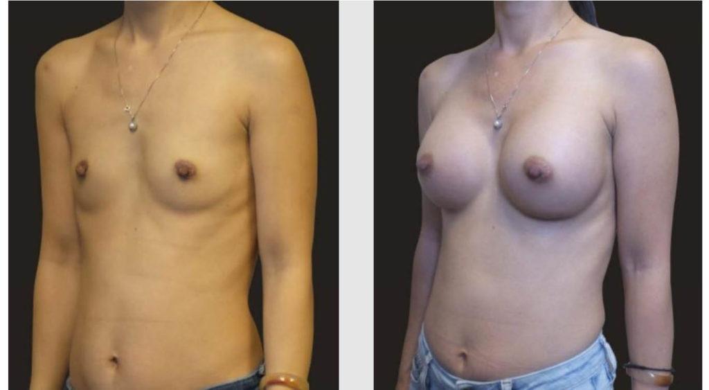 A Before and After photo of a Breast Augmentation Plastic Surgery by Dr. Craig Jonov in Seattle and Tacoma