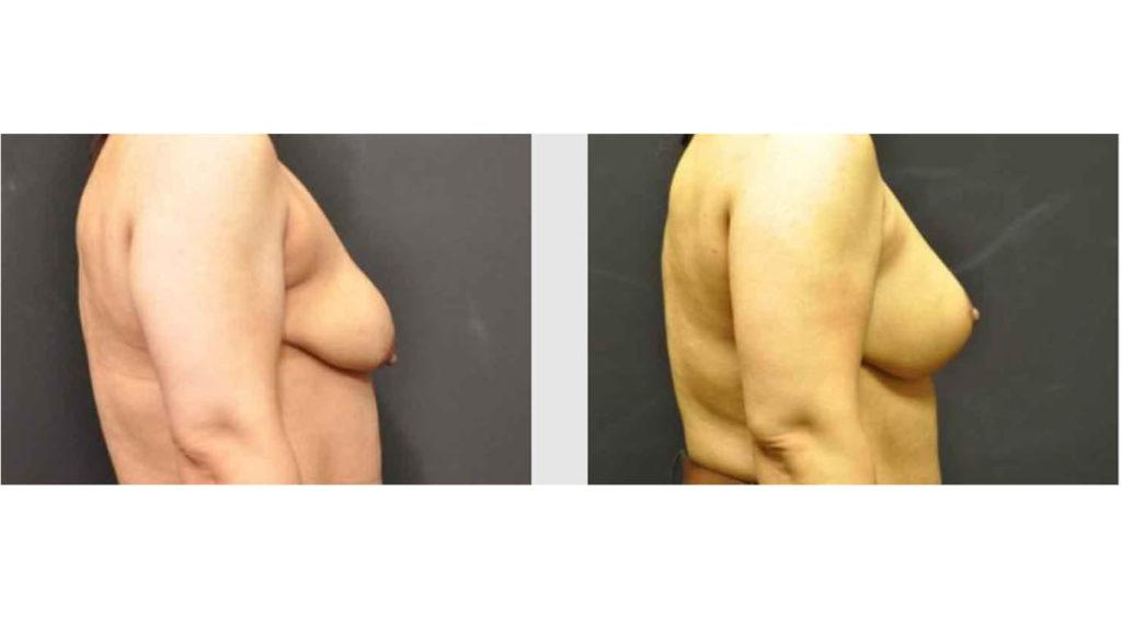 A Before and After photo of a Breast Lift Plastic Surgery by Dr. Craig Jonov in Seattle and Tacoma