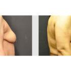 A Before and After photo of a Breast Lift Plastic Surgery by Dr. Craig Jonov in Seattle and Tacoma