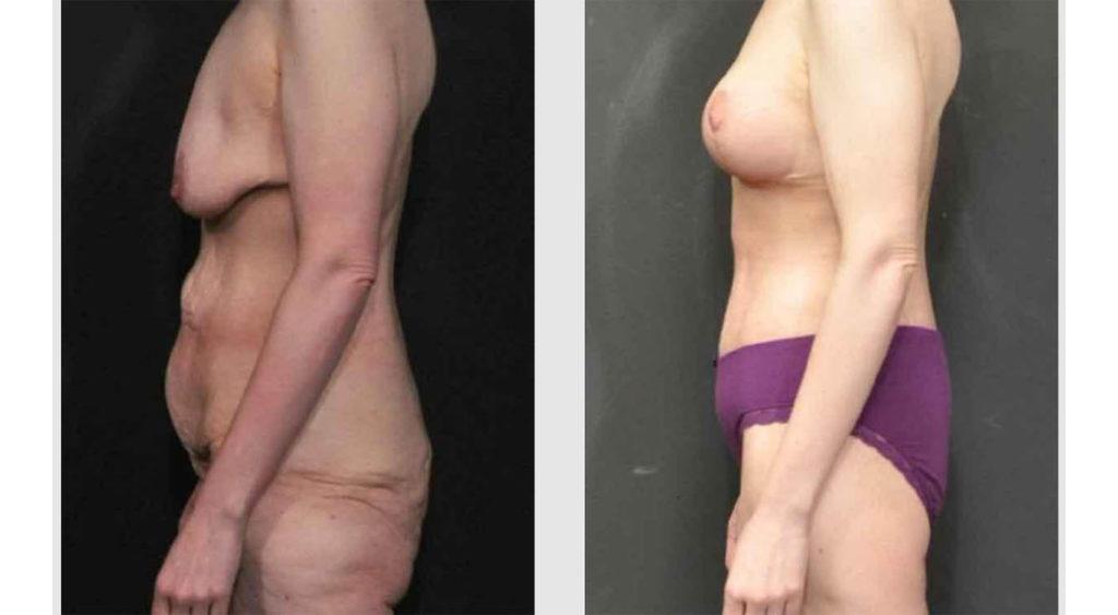 A Before and After photo of a Mommy Makeover Plastic Surgery by Dr. Craig Jonov in Seattle and Tacoma