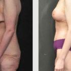 A Before and After photo of a Mommy Makeover Plastic Surgery by Dr. Craig Jonov in Seattle and Tacoma