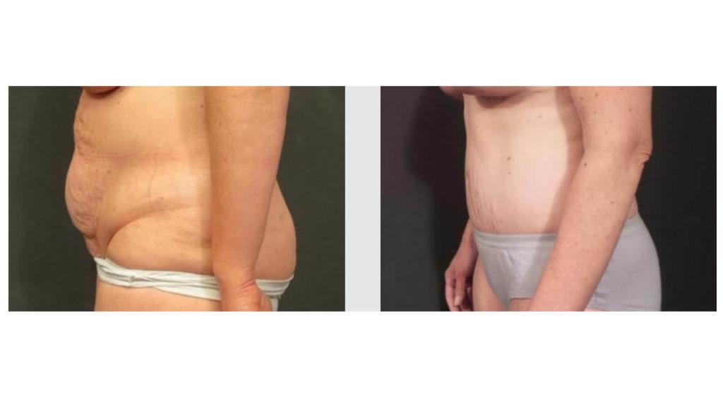 A Before and After photo of a Tummy Tuck Plastic Surgery by Dr. Craig Jonov in Seattle and Tacoma