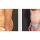 A Before and After photo of a Tummy Tuck Plastic Surgery by Dr. Craig Jonov in Seattle and Tacoma