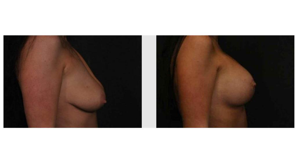 A Before and After photo of a Breast Augmentation Plastic Surgery by Dr. Craig Jonov in Seattle and Tacoma