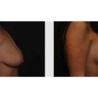 A Before and After photo of a Breast Augmentation Plastic Surgery by Dr. Craig Jonov in Seattle and Tacoma