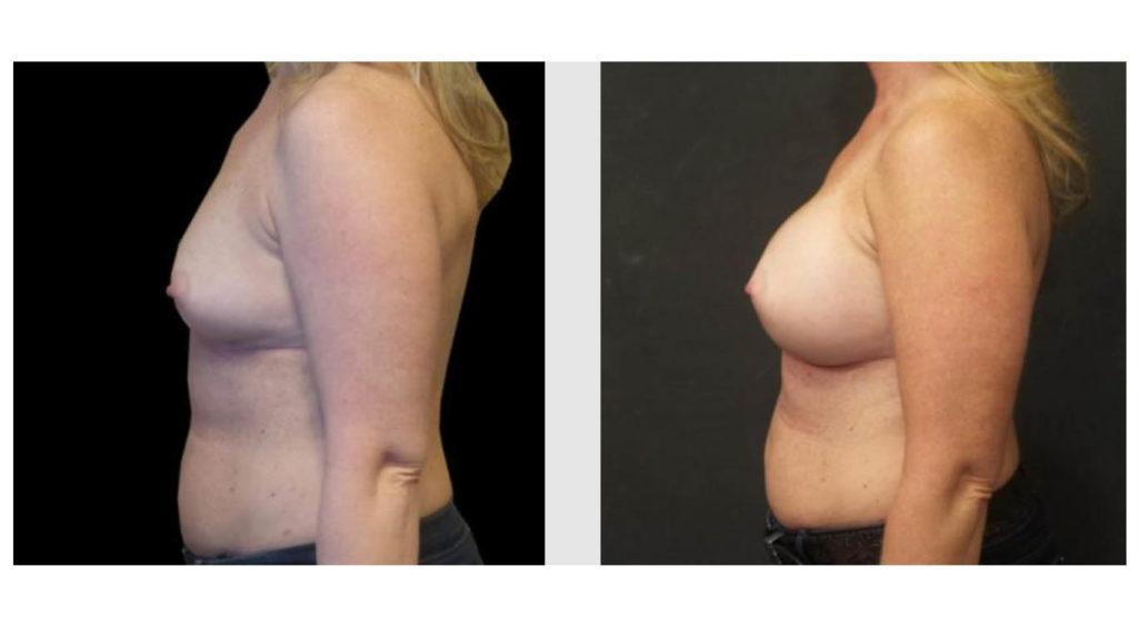 A Before and After photo of a Breast Augmentation Plastic Surgery by Dr. Craig Jonov in Seattle and Tacoma