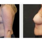 A Before and After photo of a Breast Augmentation Plastic Surgery by Dr. Craig Jonov in Seattle and Tacoma