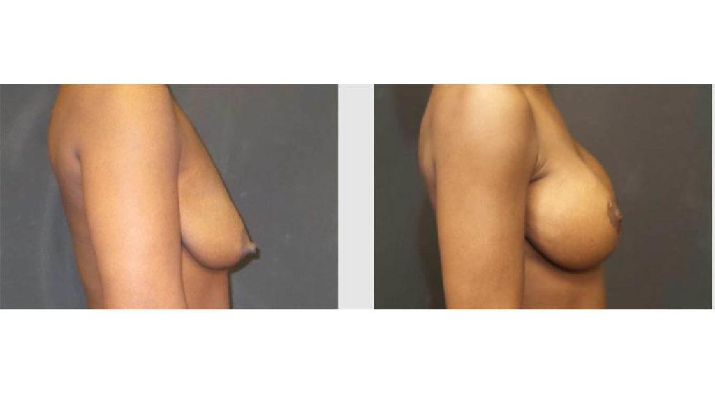 A Before and After photo of a Breast Lift Plastic Surgery by Dr. Craig Jonov in Seattle and Tacoma