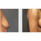 A Before and After photo of a Breast Lift Plastic Surgery by Dr. Craig Jonov in Seattle and Tacoma