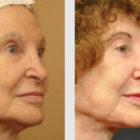 A Before and After photo of a Facelift Plastic Surgery by Dr. Craig Jonov in Seattle and Tacoma