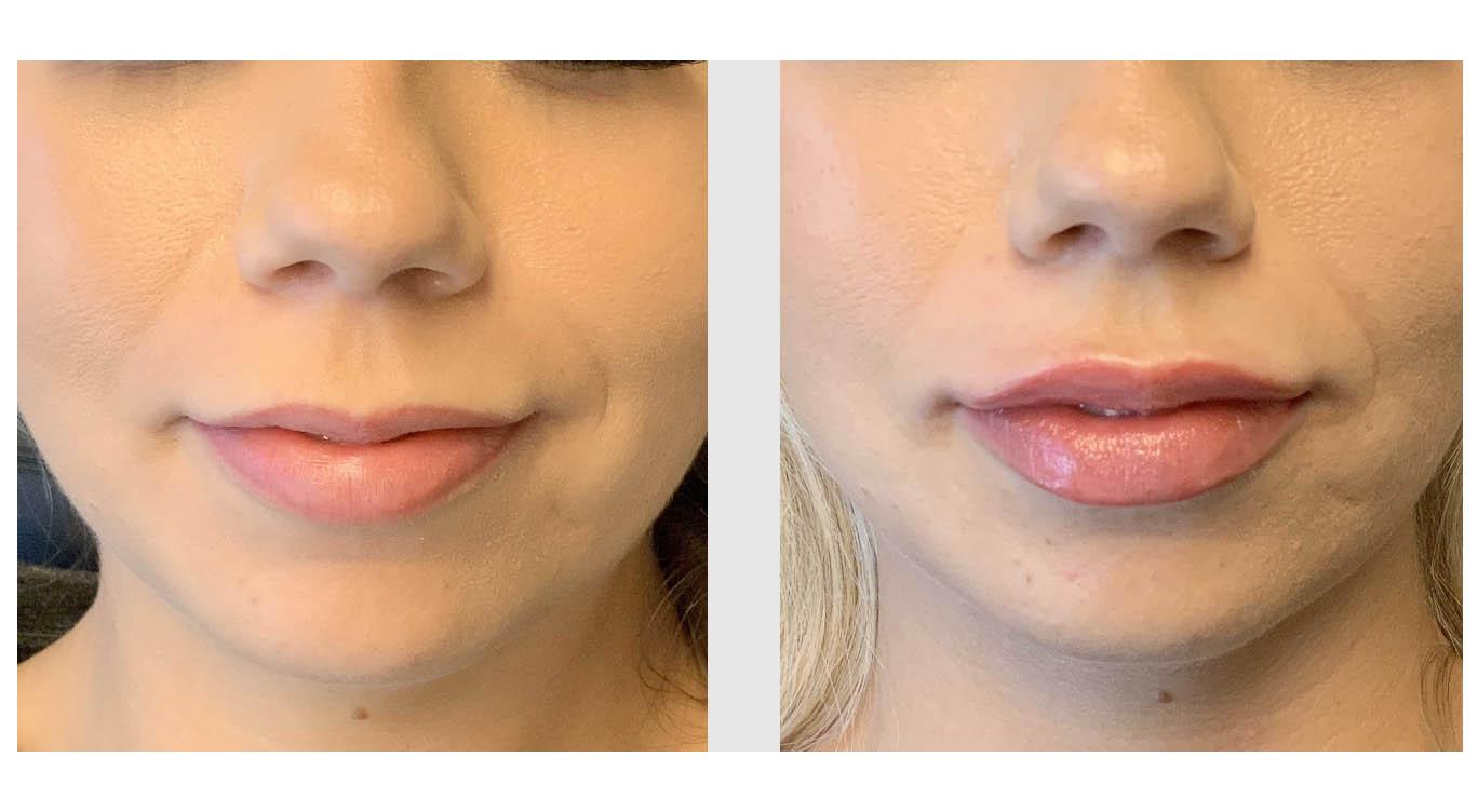 A Before and After photo of Restylane Defyne Lip Filler at Seattle Plastic Surgery in Seattle and Tacoma