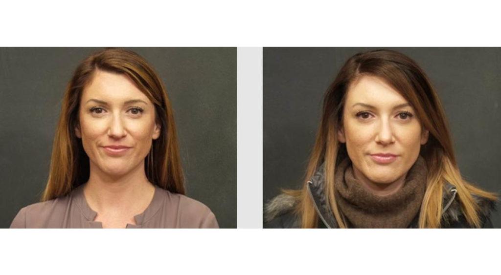 A Before and After photo of a Nose Job Plastic Surgery by Dr. Craig Jonov in Seattle and Tacoma