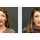 A Before and After photo of a Nose Job Plastic Surgery by Dr. Craig Jonov in Seattle and Tacoma