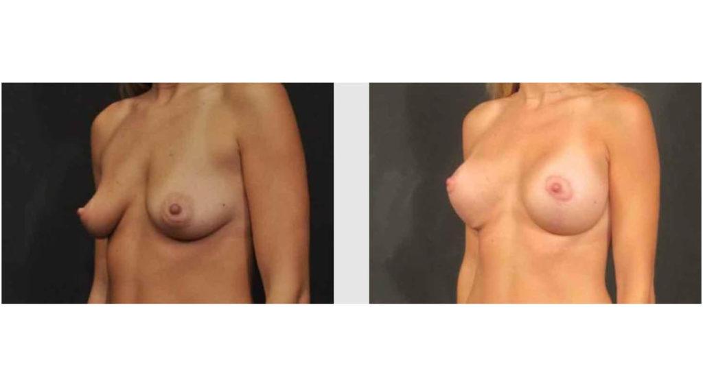 A Before and After photo of a Breast Lift Plastic Surgery by Dr. Craig Jonov in Seattle and Tacoma