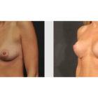 A Before and After photo of a Breast Lift Plastic Surgery by Dr. Craig Jonov in Seattle and Tacoma