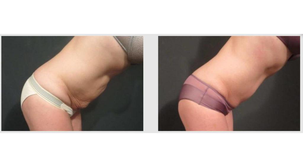 A Before and After photo of a Liposuction Plastic Surgery by Dr. Craig Jonov in Seattle and Tacoma