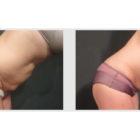 A Before and After photo of a Liposuction Plastic Surgery by Dr. Craig Jonov in Seattle and Tacoma