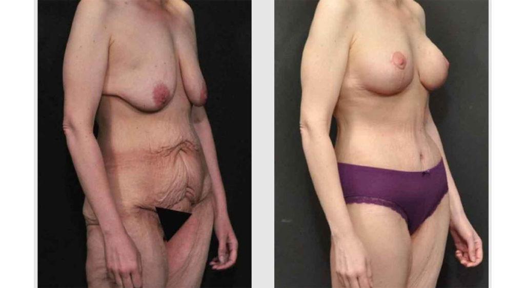 A Before and After photo of a Breast Augmentation Plastic Surgery by Dr. Craig Jonov in Seattle and Tacoma