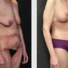 A Before and After photo of a Breast Augmentation Plastic Surgery by Dr. Craig Jonov in Seattle and Tacoma