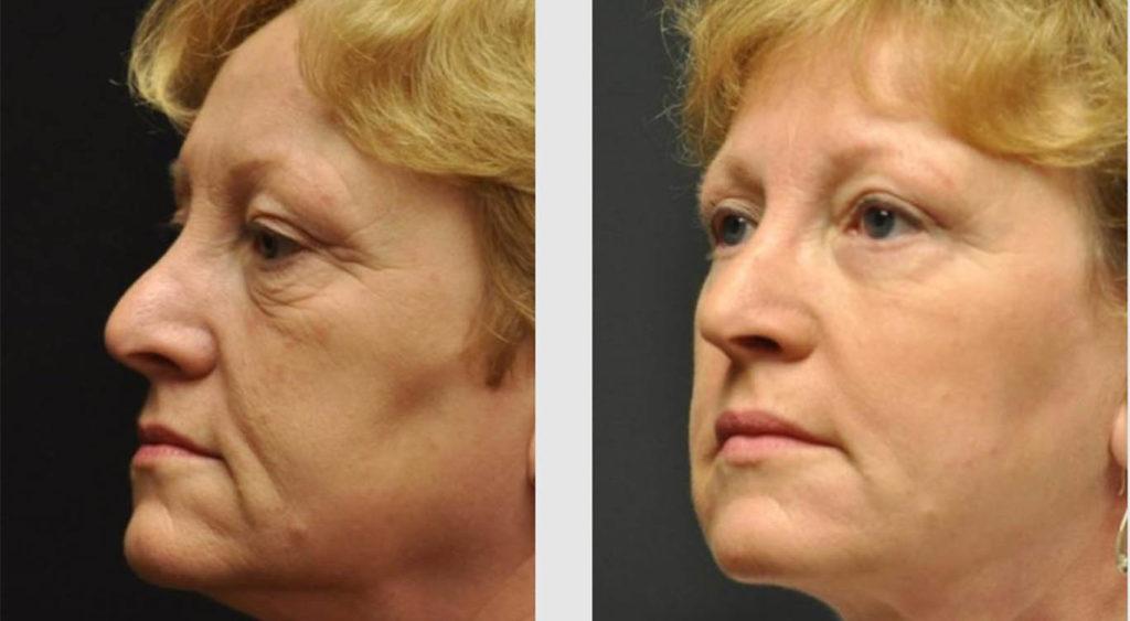 A Before and After photo of an Eyelid Lift Plastic Surgery by Dr. Craig Jonov in Seattle and Tacoma